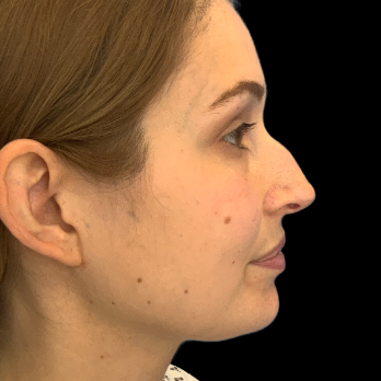 ultrasonic-rhinoplasty-before